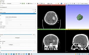 3D-slicer血肿建模flood filling
