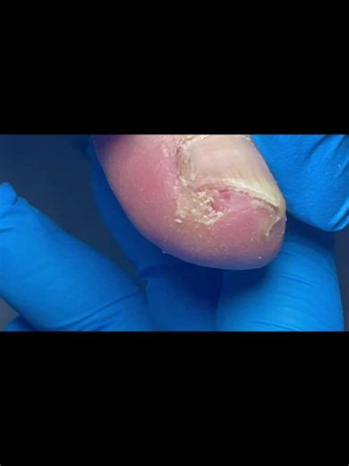 Quickly trim away the ingrown nail! #nails #pedicure