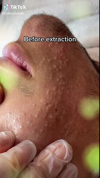 Before and after skin extraction #viral #extractions #acne #acneremoval #acnetreatment #facial #orlandoflorid