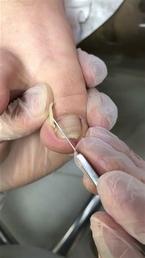 The tip of the nail has grown inwards. #nails #satisfying