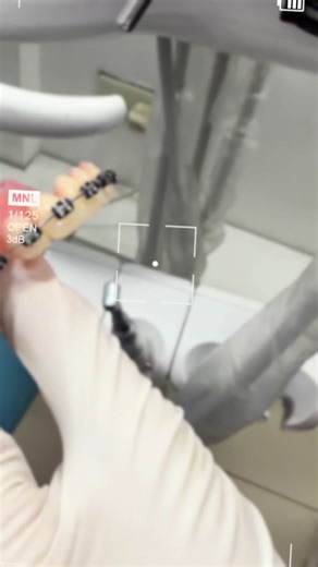 Exploring Dentures with Braces: What You Need to Know