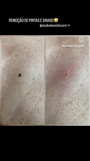 Remoção de pintas, verrugas e sinais através de cauterização a laser