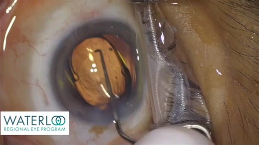Cataract surgery with multifocal IOL implant - 白内障手术联合多焦人工晶体植入