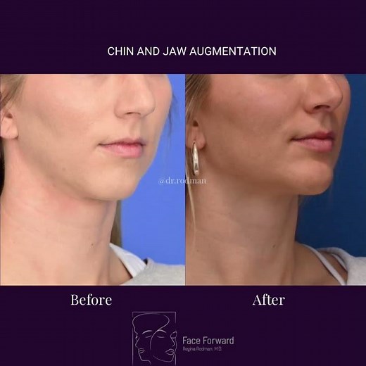 Genioplasty| Jaw Augmentation| Facial Plastic Surgery