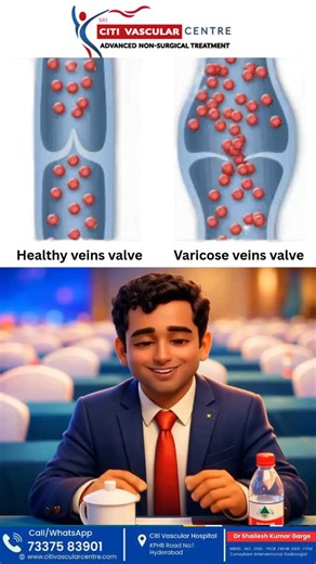 Dr. Shailesh kumar Garge | 🔴 Normal vein vs Varicose vein: See valve failure! Blood pools → pain/swelling. Laser fixes in 30 mins!Citi Vascular Hospital KPHB | Dr... | Instagram