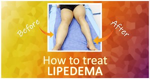 2K views · 22 reactions | #LIPEDEMA TREATMENT by LIPOSUCTION!!...