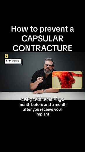 How to prevent a capsular contracture #plasticsurgery #medicine #educateyourself #breastaugmentation #breastimplant