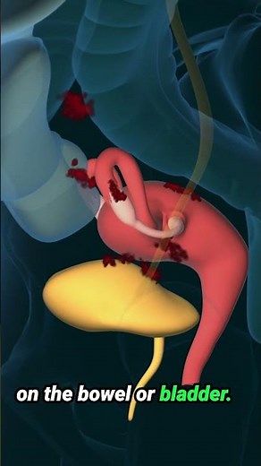 Endometriosis Explained #pain