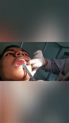 retained deciduous BDR #rightupper c #youtubeshorts #clinic #dentalclinic #foryou #doctor