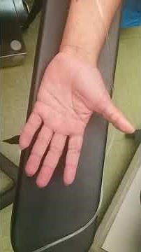 Trigger thumb clinical video