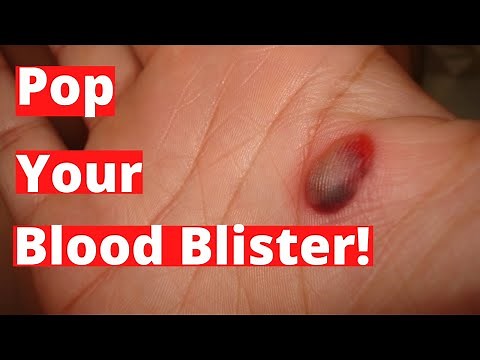 Should You Pop A Blood Blister?