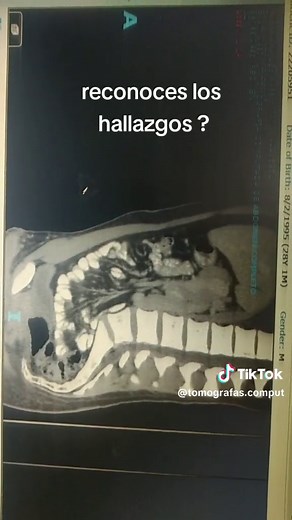 tomografías computadas abdomenpelvio#tomogrfia