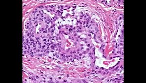 Glomus Tumor Excision