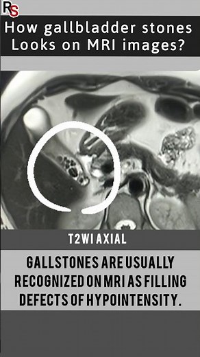 How gallbladder stones look on MRI Images #radiology #mri #shorts