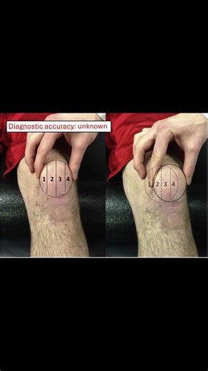 Patellar Glide Test 🦵 #kneepain #ortho #medicaleducation #meded #physio #ATC