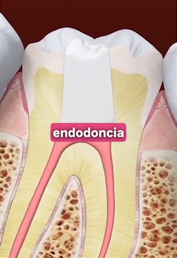 Endodoncia y Cuidados del Dolor de Muela