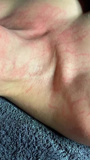 Fresh blood after an Enzyme! Healthy skin what’s up? 🤩#fyp #skincare #facialtreatment #skincareroutine #dmkskin #plasmatic #enzymemask @dmk.anz