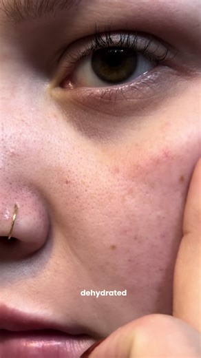 Dehydrated vs Hydrated Skin: Key Differences Explained