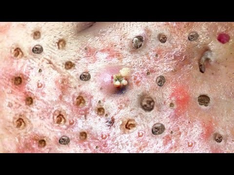 How to get rid of big pimples on your face#06 #acne #acneremoval #extraction #acnetreatment