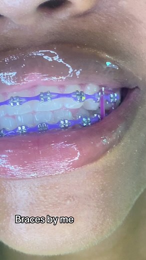 Elegant Braces Styles for Girls: Beautiful Color Options