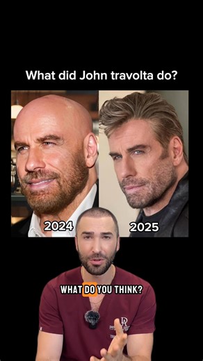 John Travolta is 71 this year… and somehow looks younger than he did last year 🔥 His jawline is sharper, cheeks more lifted, forehead smoother and his skin? Even, glowing, and radiant. What could be behind this transformation? ✨ Subtle fillers skin-tightening threads for jawline & cheeks ✨ Botox to smooth forehead lines ✨ Laser resurfacing or chemical peels for that even tone ✨ Microneedling to boost texture and glow ✨ Maybe even a little help with the hair for the full effect This is modern ae