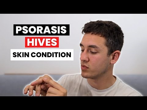 MY EXPERIENCE WITH PSORIASIS AND HIVES