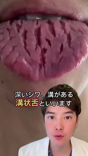 溝状舌(Fissured Tongue)について説明します🙋‍♂️ ↓ [溝状舌とは] 溝状舌（こうじょうぜつ）とは、舌の表面に多くの深いシワ、溝が形成されるので、舌が割れてしまったように見える状態です。 溝状舌の原因としては、おおむね2つの要因があり、先天的要因と後天的要因に分けられます。 〜先天性要因について〜 溝状舌のほとんどのケースが先天性溝状舌で、形成異常や奇形、変形症といった疾患に分けられます。 溝状舌は遺伝によって数代に渡り、同一家族内に発生が見られる場合も少なくありません。 このように生まれついて舌にひび割れが見られる方は、特に治療の必要性はなく経過観察が一般的です。 〜後天的要因について〜 ・感染 細菌感染や、結核や梅毒といった特殊な感染症、カンジダ症、ウイルスによる単純性疱疹などで溝状舌が見られる場合があります。 このような感染症が起因しているものは、痛みを伴うケースが多いです。 ・外傷 誤って舌を噛んでしまう、むし歯などで尖ってしまった歯や不適合のつめ物、熱い食べ物による火傷など、これらの外傷によって舌が傷つき、炎症が起きることで細菌に感染して腫れたり、化膿した