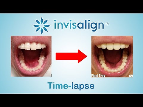 Invisalign Full Time-lapse