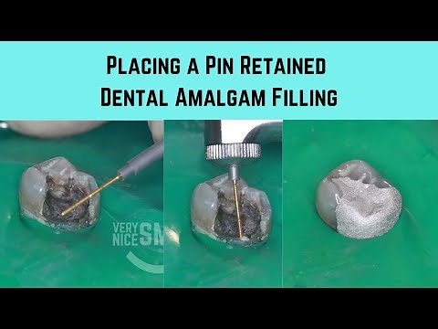 Placing a pin retained Dental amalgam filling