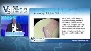 Spider Veins Pathophysiology and Treatment Insights