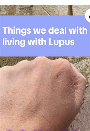 Living with Lupus: Challenges and Insights