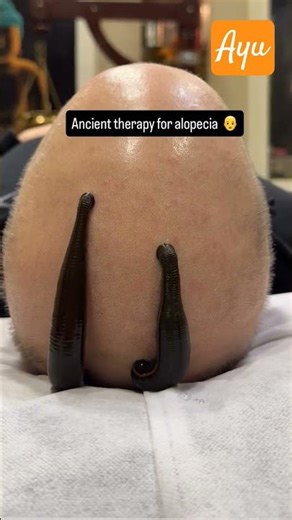 Leech therapy for alopecia #ayurved #leechtherapy #alopecia