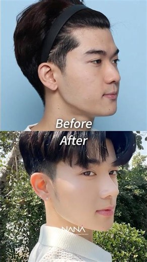 Starting to look how I always imagine! #koreaplasticsurgery