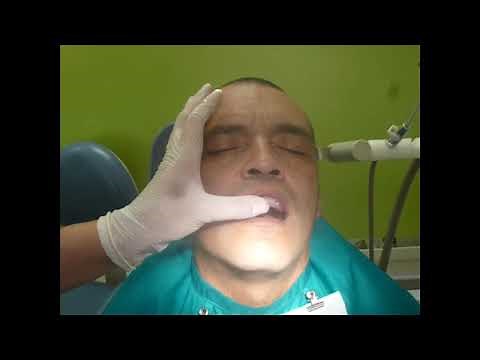 Impresion definitiva en paciente desdentado parcial