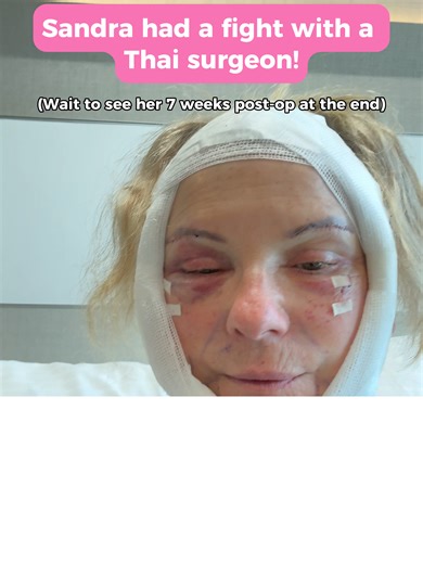 Transform Your Look: Sandra's 7-Week Surgery Journey