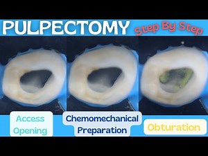 Pulpectomy | Step By Step Demonstration  • Video • MEDtube.net