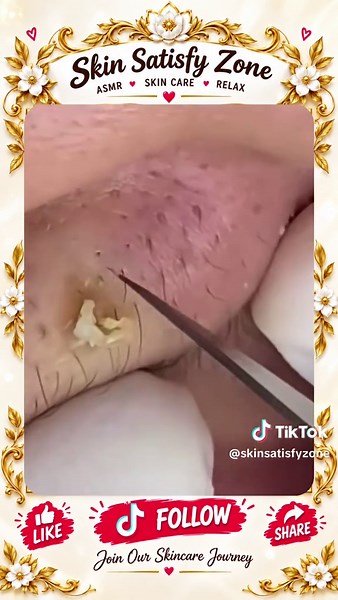 Deep Blackhead Extraction & Satisfying Popping | Wait for the most satisfying pop 😳🫣 You won’t believe what comes out! #pimplepoppersatisfying #Acne #pimple #Blackhead #Satisfying