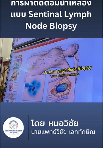 การผ่าตัดต่อมน้ำเหลือง Sentinel Lymph Node Biopsy @@Wichai Ekataksin, M.D., Ph.D.##หมอวิชัยเอกทักษิณ##บ้านอาศรม##ศูนย์น้ําเหลืองดีไม่มีโรค##น้ําเหลืองไม่ดี##ผ่าตัด##เทรนด์วันนี้