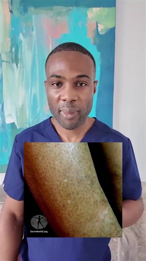 Understanding White Spots on Skin: Idiopathic Guttate Hypomelanosis