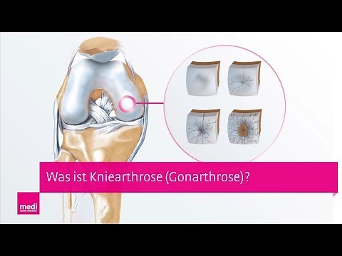 Arthrose im Knie | Was ist Gonarthrose (Kniearthrose)? – Ein Blick ins Innere des Kniegelenks