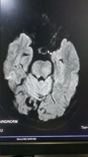The Future of Brain Imaging: Diffusion Weighted Imaging Explained