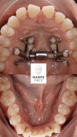 Dr. Svitlana Koval on Instagram: "Bone expansion 7.5 mm Mandibular expansion 5.0 mm MARPEFACE™️ protocol Midfacial expansion and Shape Memory Aligners Stay tuned 😎 #drkovalorthodontics #airwayorthodontics #airways #marpe #fme #marpeface™️ #bocaraton #boca"