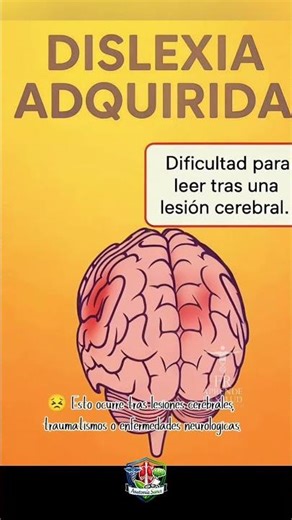 Dislexia adquirida y el cerebro 🧠⚠️ #Dislexia #Neurología #Salud