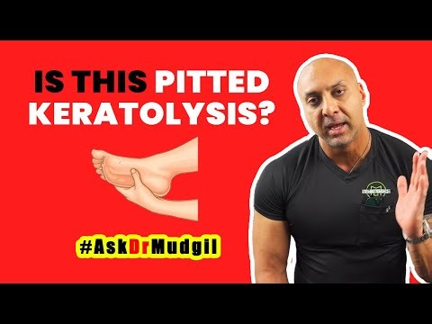 IS THIS PITTED KERATOLYSIS?