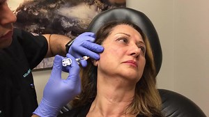 MMLift - Restylane Lyft for the Jawline