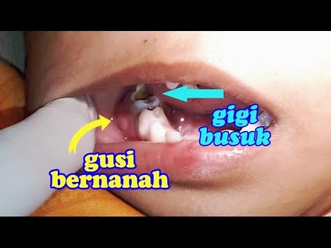 Merawat gusi bernanah dan bengkak, sakit gigi pd balita anak umur 3 tahun. Dokter gigi Jogja