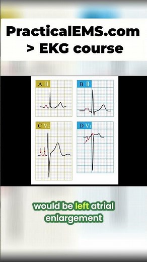 ECG Reading Decoded: Unveiling Left Atrial Enlargement Secrets! #shorts