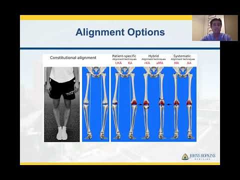 Kinematic Alignment (KA) for Arthritic Knee Conditions | Dr. Savya Thakkar