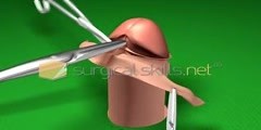 3D video of Circumcision