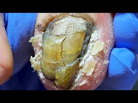 Green Toenails, Cut Off The Onychomycosis Step By Step! 【Dr Liu's Pedicur】